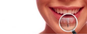 dental implants procedure kirkland wa